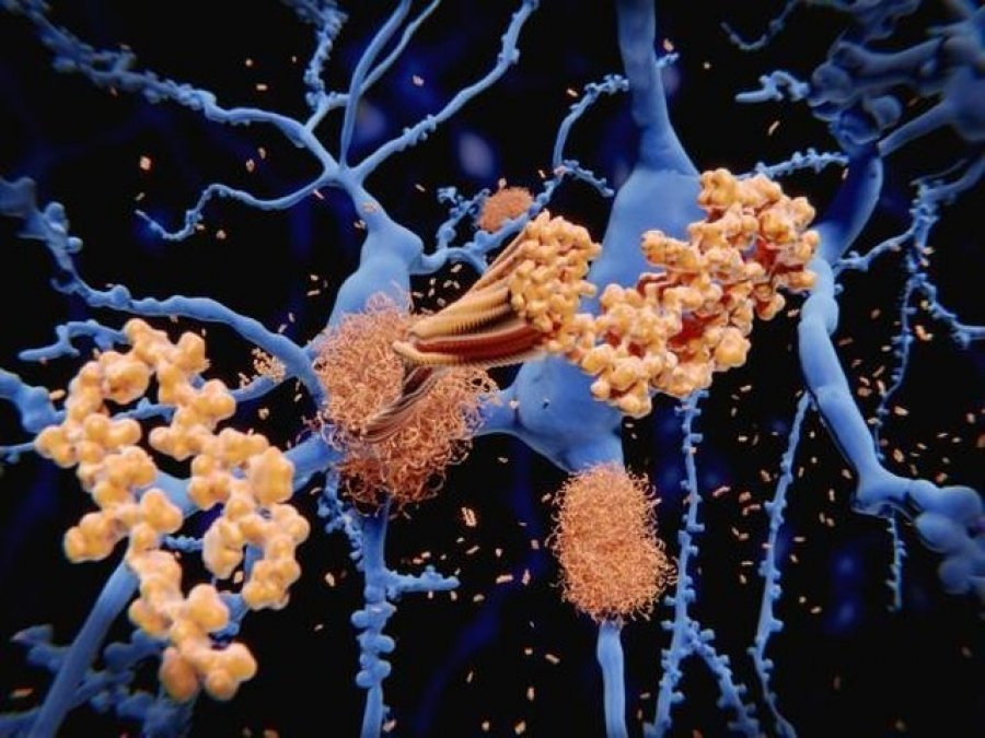 Identifikohet mekanizmi që bllokon proteinat toksike të Alzheimerit